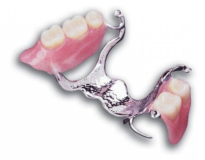 Ковид зубова. Стоматология бюгельные протезы. Бюгельный протез (2-3 кламмера). Что такое бюгельный протез в стоматологии. Бюгельный протез с кламмерами.
